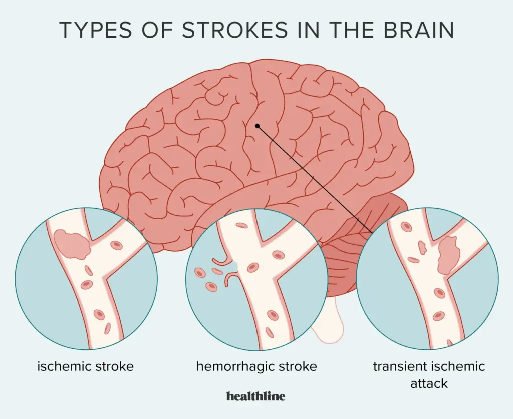Could you explain the three distinct types of stroke? Doctor Near Me