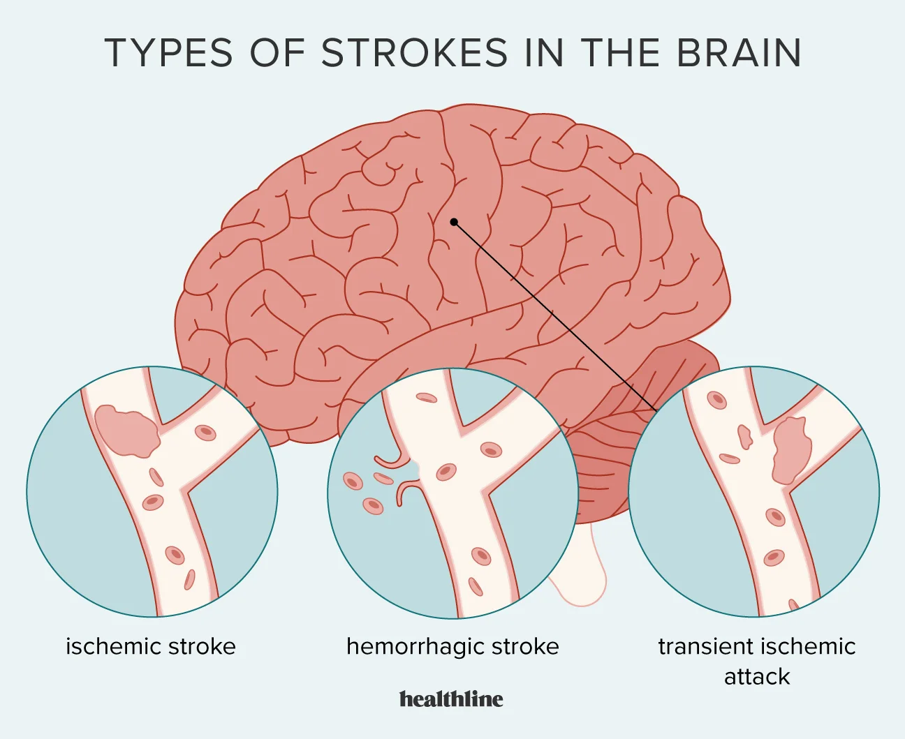 Could you explain the three distinct types of stroke?