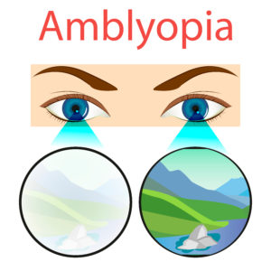 What is amblyopia (lazy eye) and how is it treated?