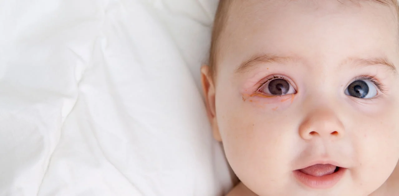 What are some examples of eye conditions that can affect newborns?