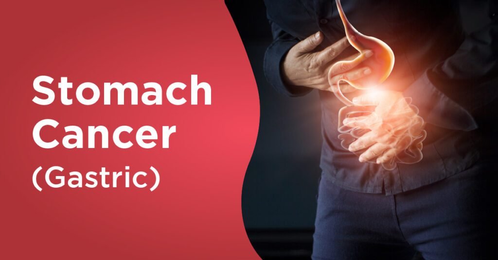What are the symptoms of stomach cancer? Doctor Near Me