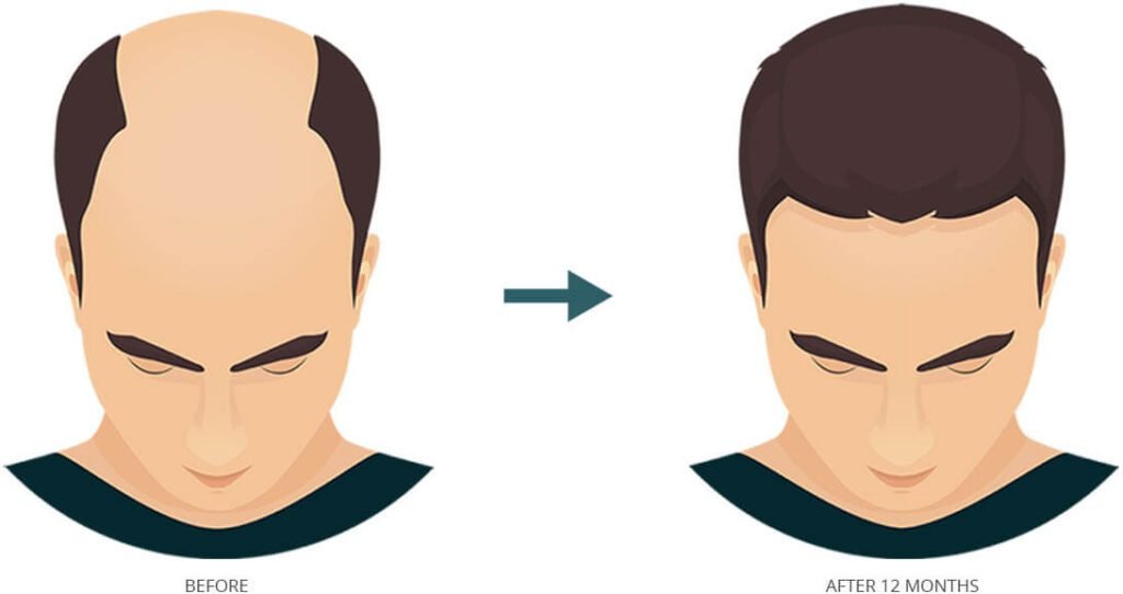Are there age restrictions for hair transplant procedures? Doctor Near Me