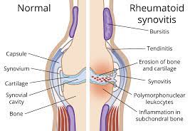 What causes rheumatoid arthritis?