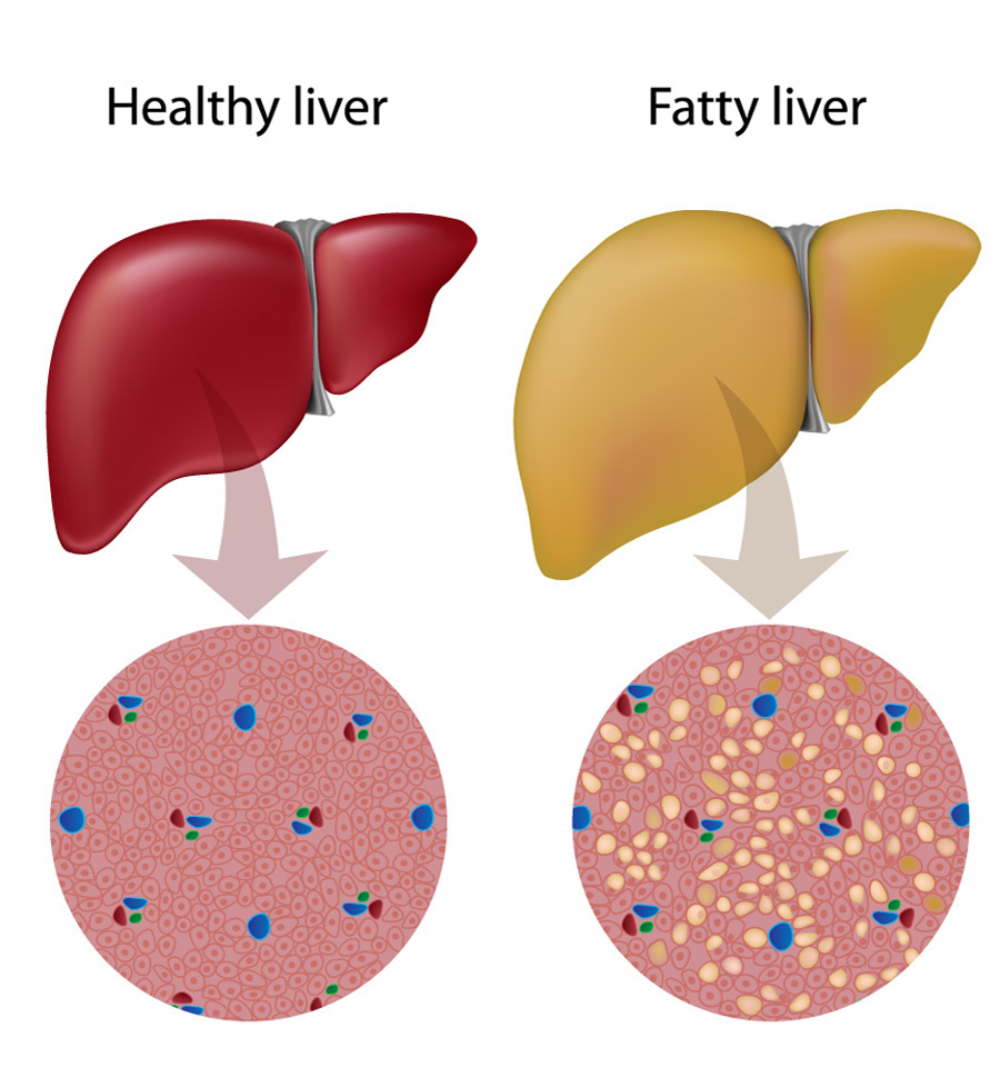 What are the symptoms of fatty liver disease?