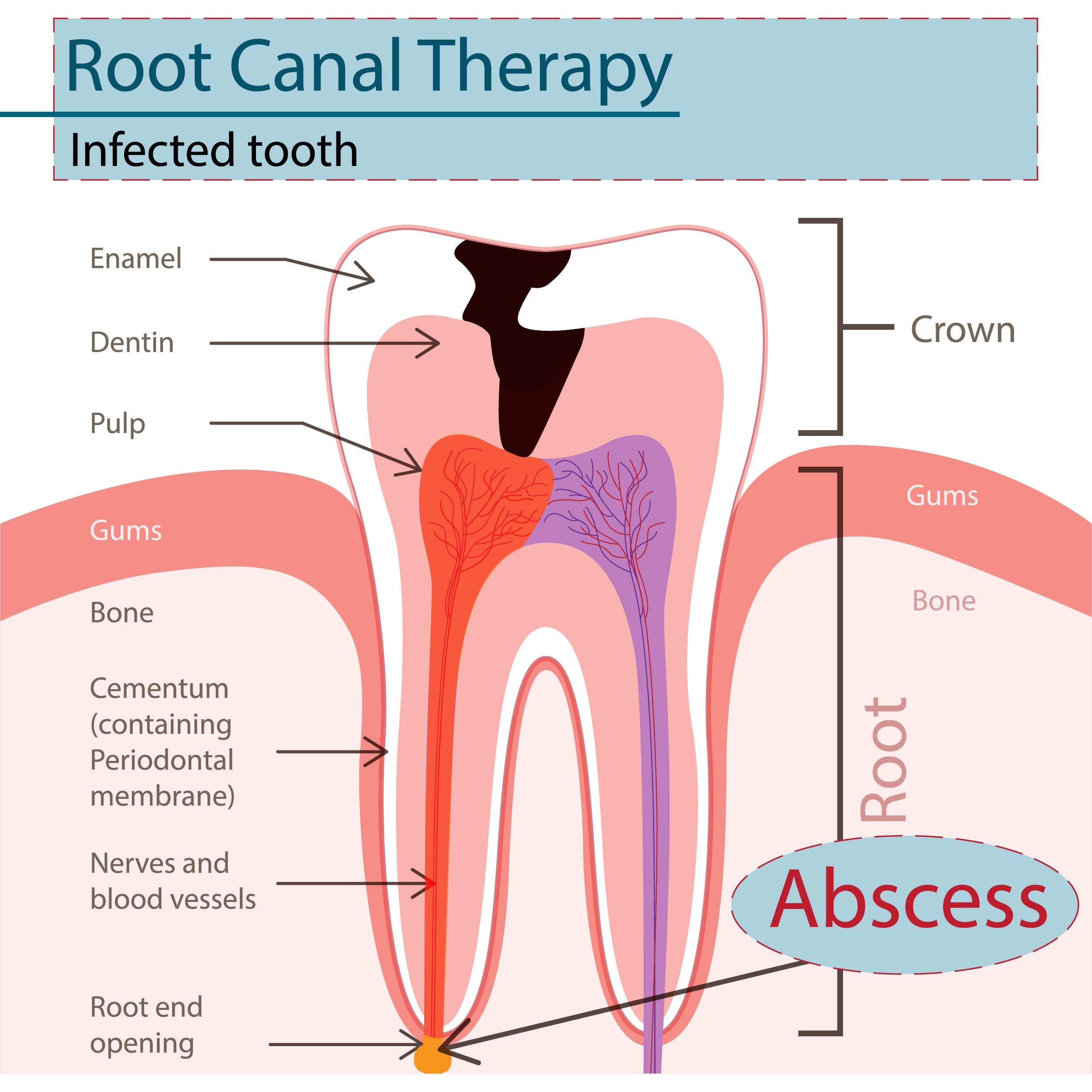 Why is a root canal necessary?