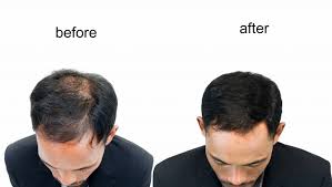 Can you get a natural-looking hairline with a hair transplant?