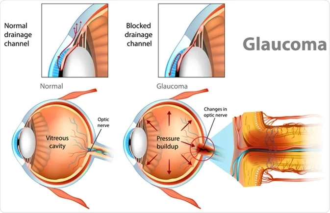 What are the various types of glaucoma?