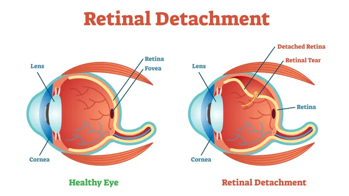 What are common retinal disorders?