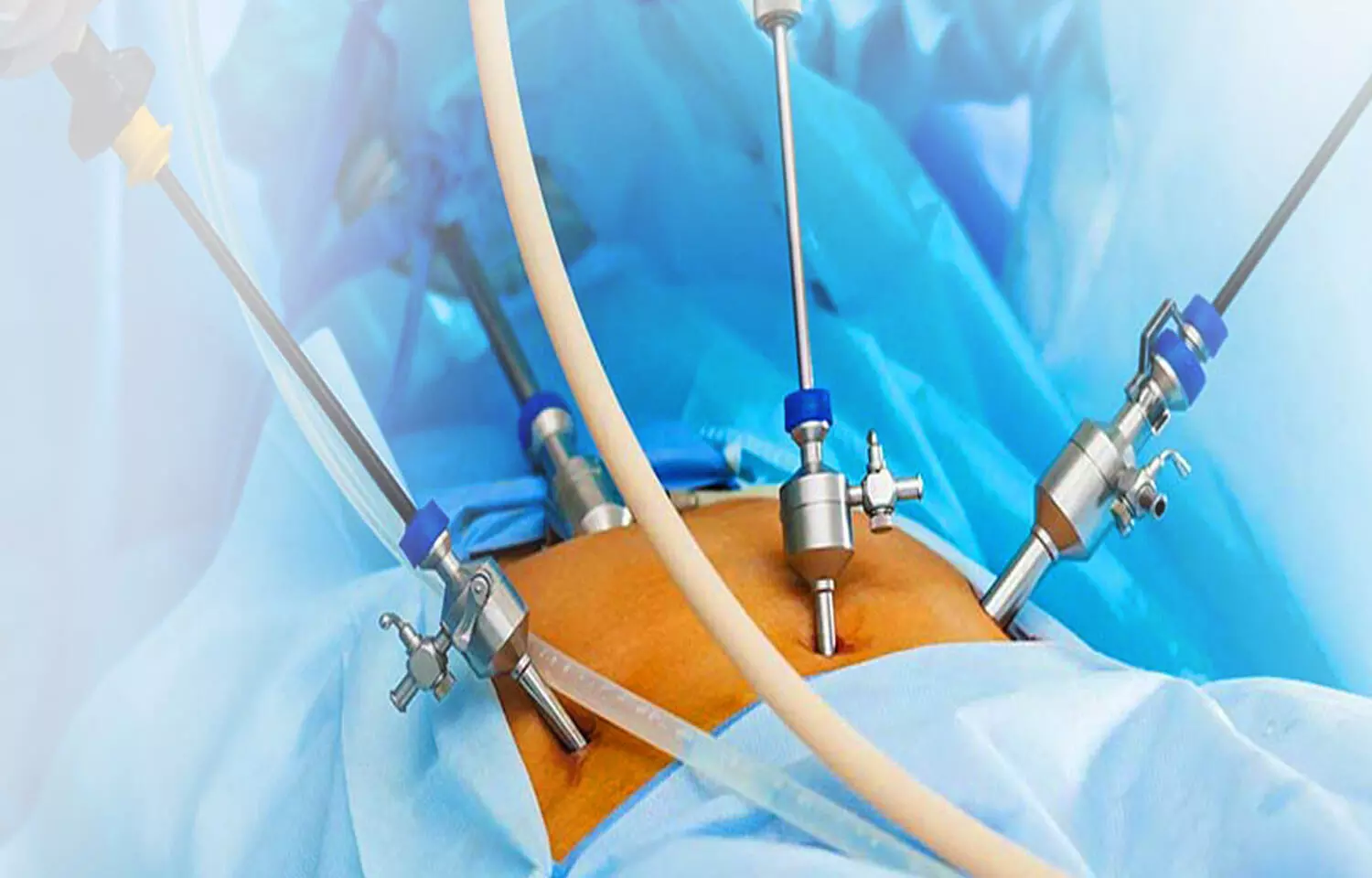 Why is Total Laparoscopic Hysterectomy (TLH) performed?