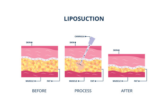 What are the risks and complications associated with liposuction?