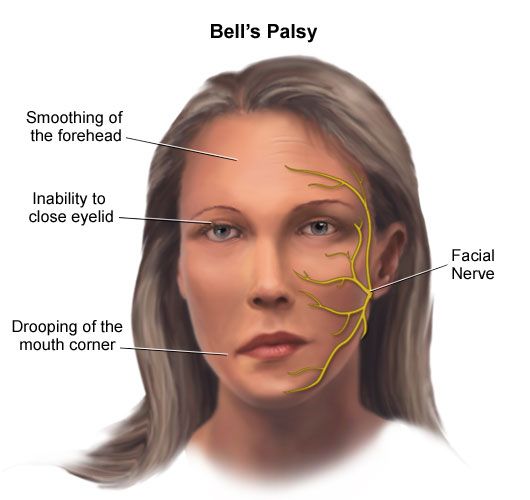 What are the common symptoms of Bell’s Palsy?