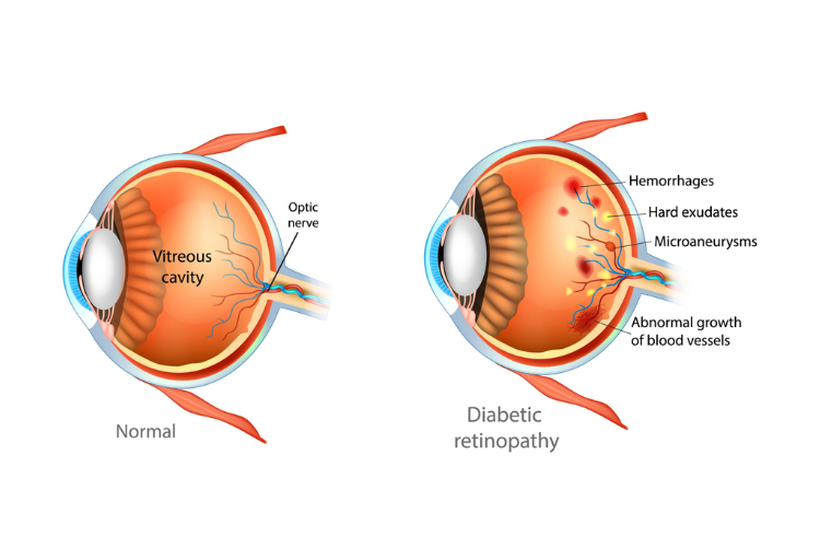 What are the symptoms of diabetic retinopathy?