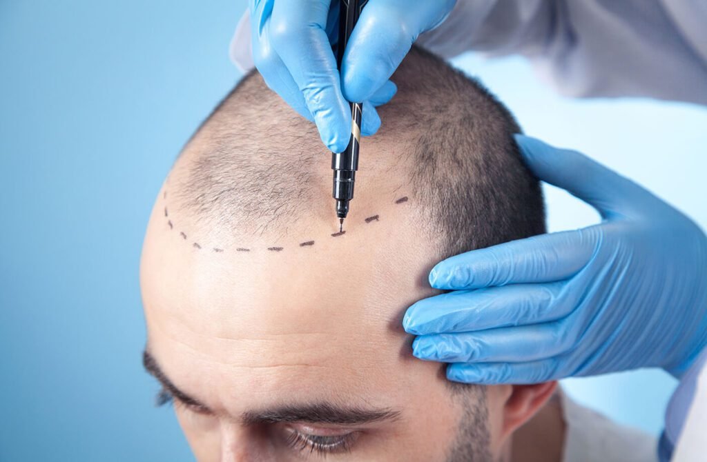 What is a hair transplant, and how does it work? Doctor Near Me