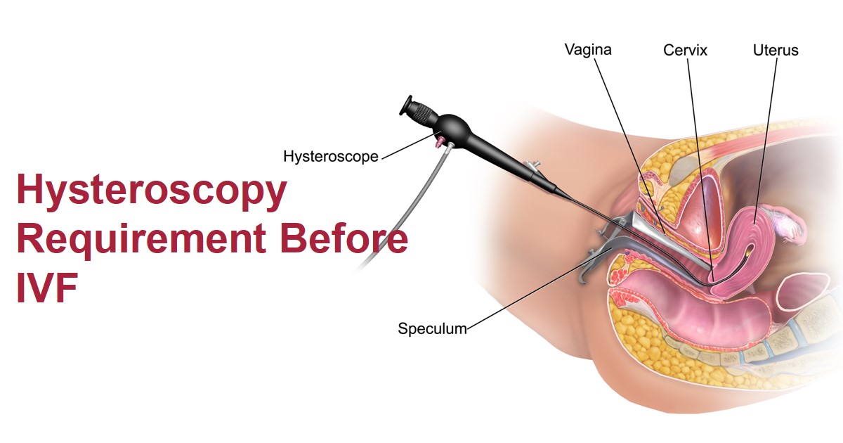 What is a pre-IVF hysteroscopy?