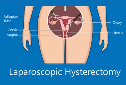 Why is laparoscopic hysterectomy performed?