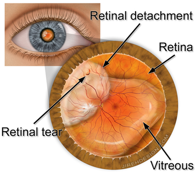 Can a damaged retina be repaired?