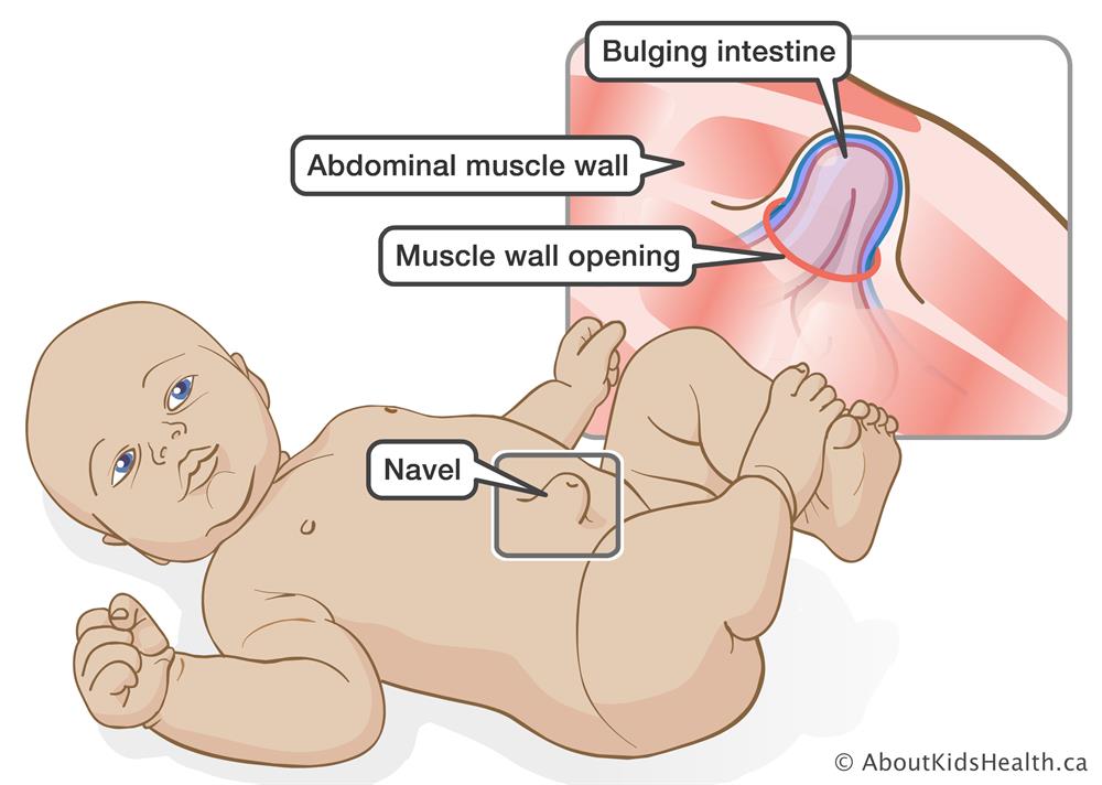 What are the symptoms of a paediatric hernia?