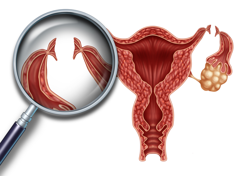 What are the advantages of tubal ligation?