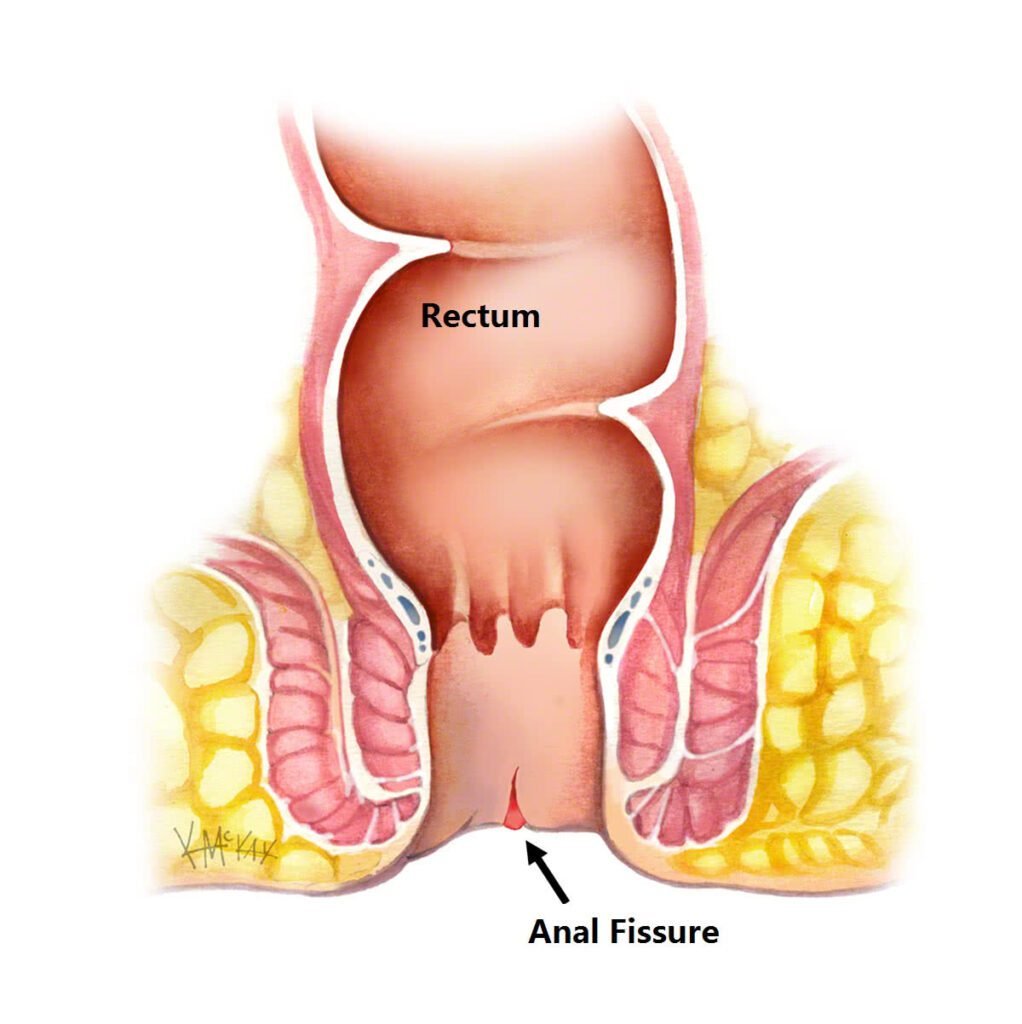 What are the symptoms of an anal fissure? Doctor Near Me