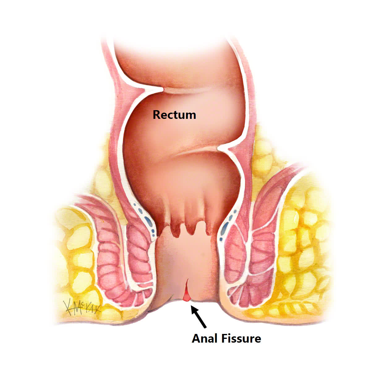 What are the symptoms of an anal fissure?