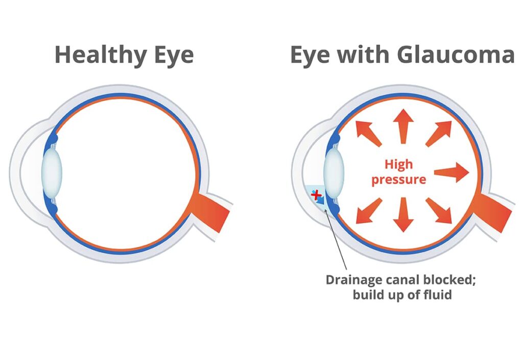 How does glaucoma affect life beyond vision?