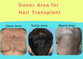 How is the donor area determined for a hair transplant?