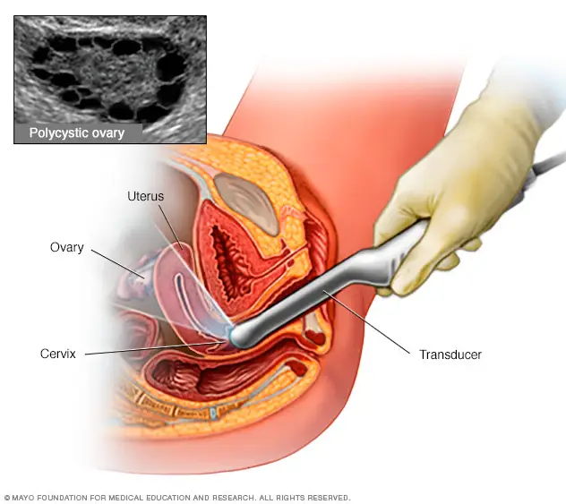 What is PCOS, and why is testing important?