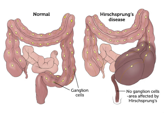 What are the common symptoms of Hirschsprung’s disease in infants and children?