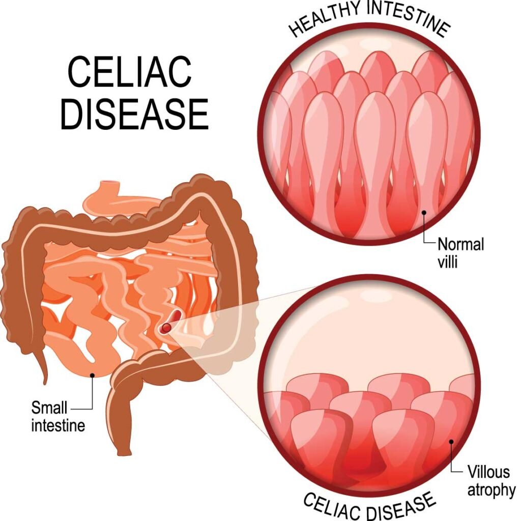 What are the common symptoms of celiac disease? Doctor Near Me