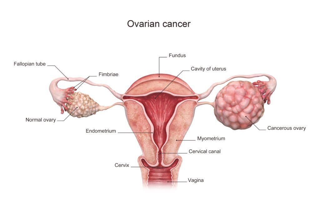 What Are the Symptoms of Ovarian Tumors? Doctor Near Me