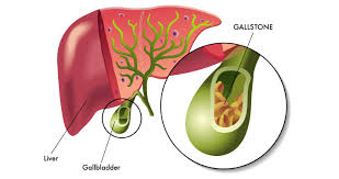 What are the symptoms of gallstones?