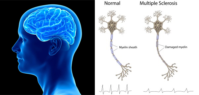 Is it possible to live a normal life with multiple sclerosis?