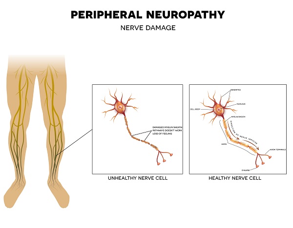 What are the common symptoms of peripheral neuropathy?