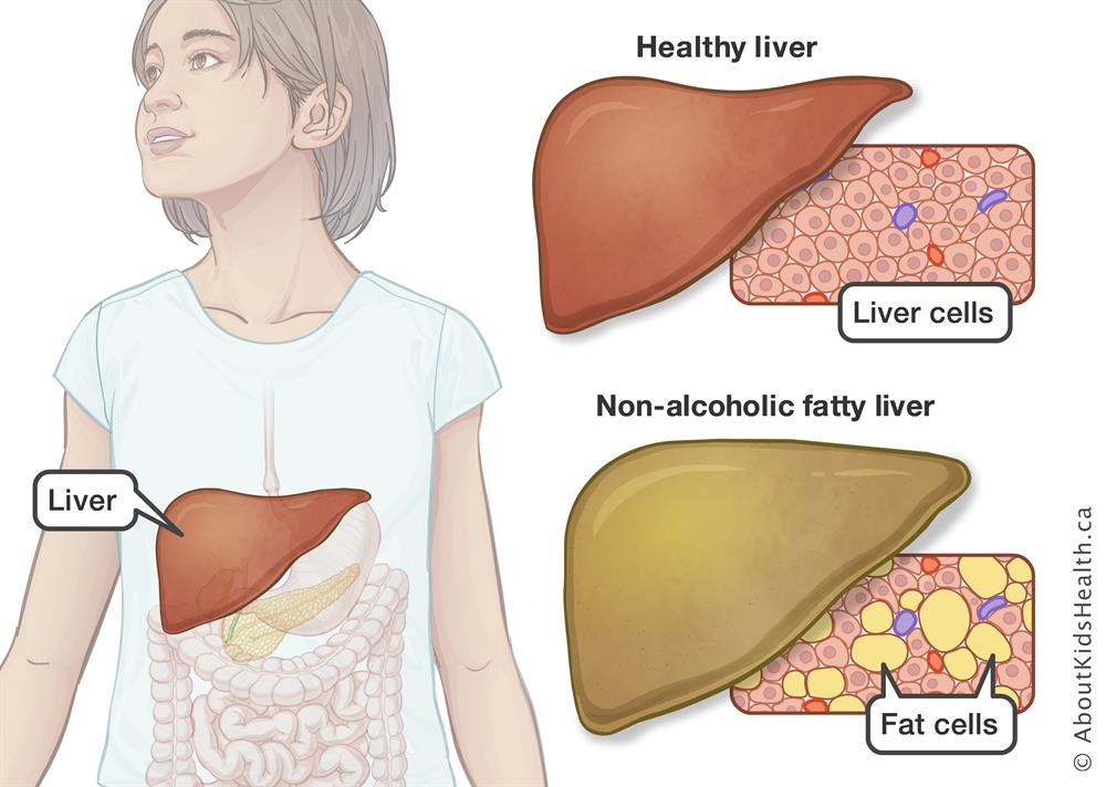 What is non-alcoholic fatty liver disease (NAFLD), and how is it diagnosed and treated?