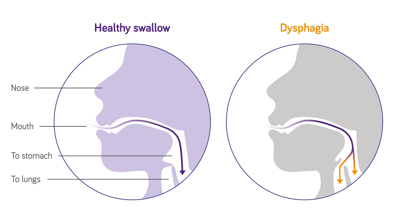 What are the common causes of dysphagia?