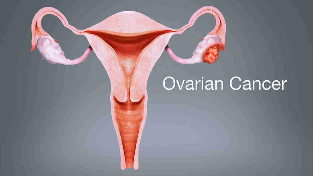 What are the symptoms of ovarian cancer?