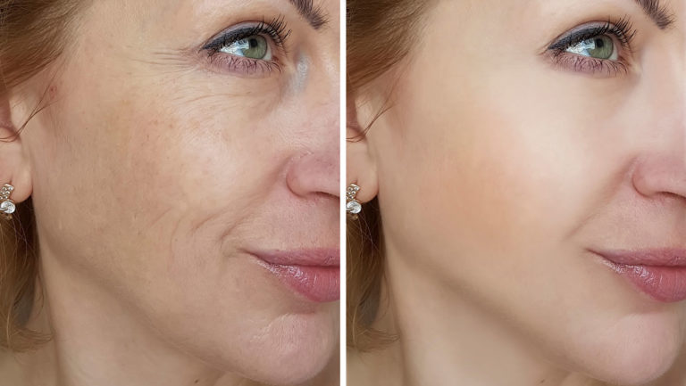 Who is a suitable candidate for skin tightening?