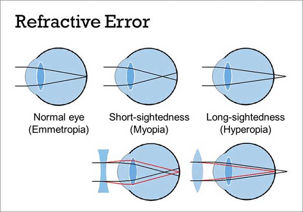 What are refractive errors in the eye?