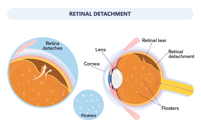 What are the symptoms of retinal detachment?