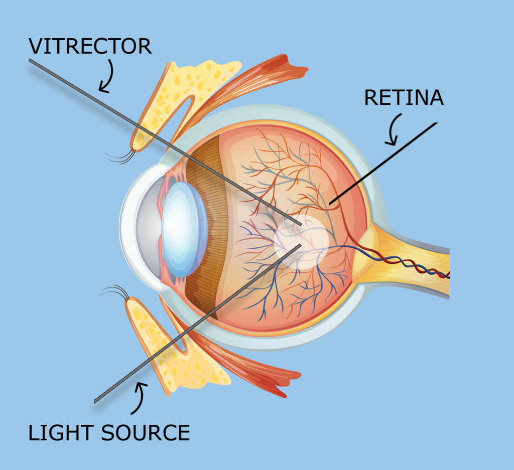 What are the common reasons for undergoing a vitrectomy?