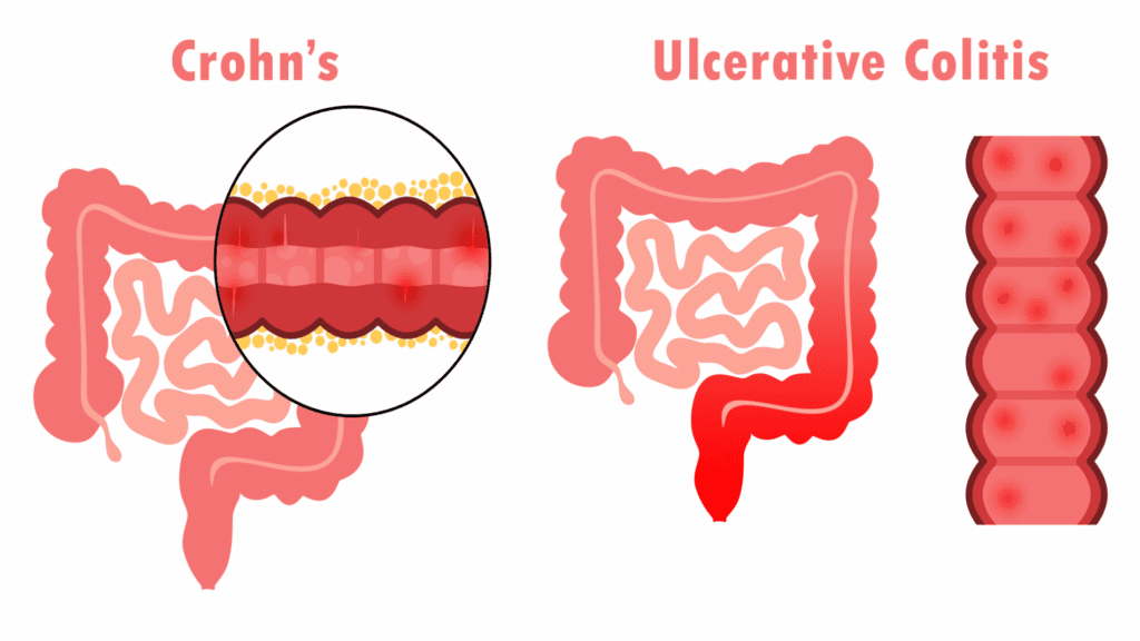 What are the treatment options for Crohn’s disease and ulcerative colitis? Doctor Near Me