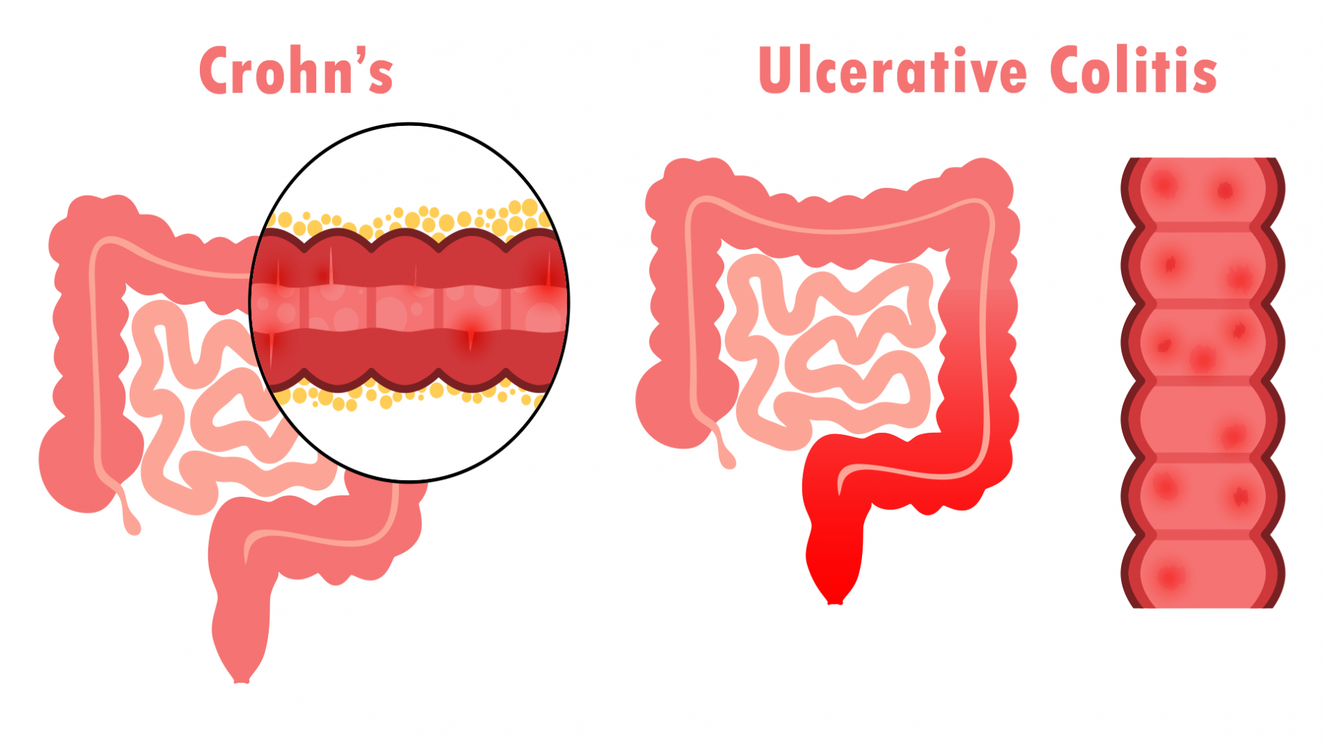 What are the treatment options for Crohn’s disease and ulcerative colitis?