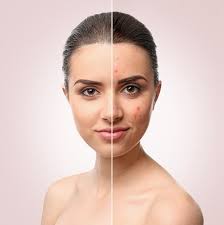 When should I see a dermatologist for acne treatment?