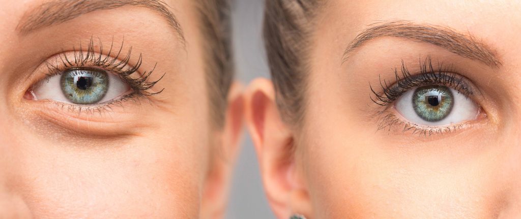 What Conditions Does Oculoplastic Surgery Address?