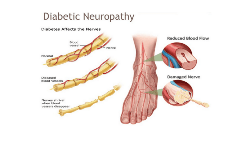 How is diabetic neuropathy managed, and can it be prevented? Doctor Near Me