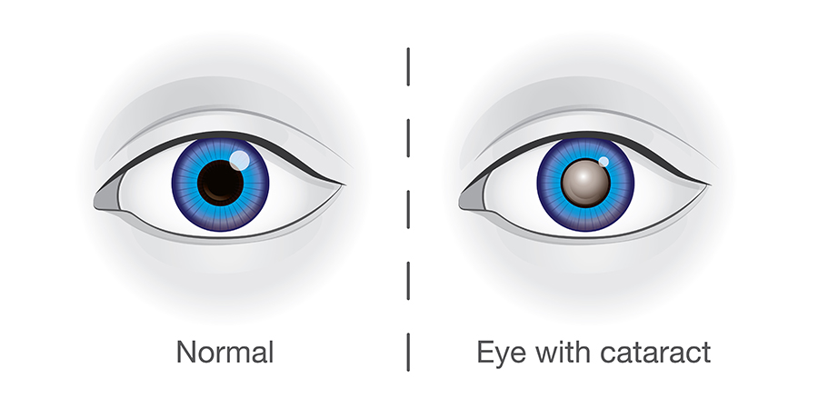 DO CATARACTS IMPACT OLDER ADULTS’ MENTAL HEALTH BEYOND VISION?