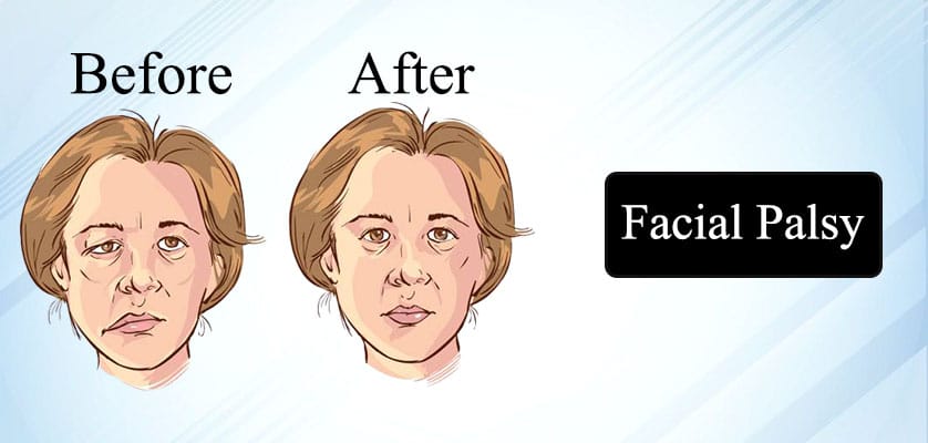 Can facial paralysis affect both sides of the face?