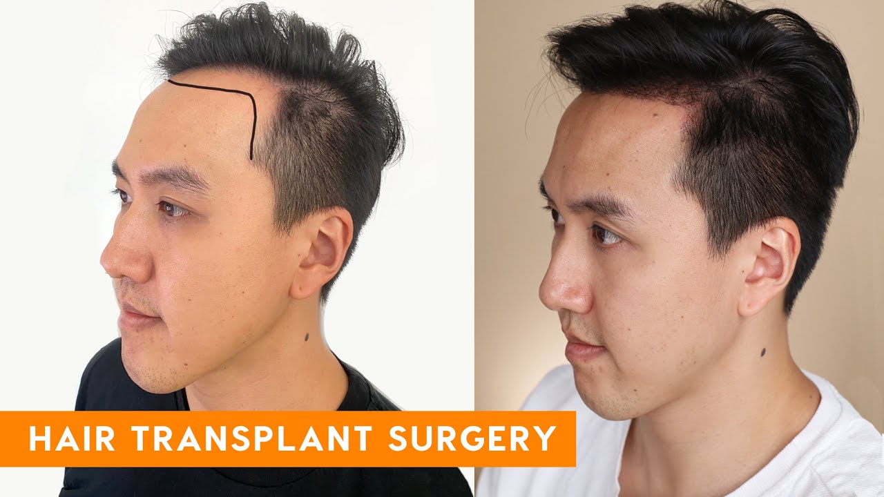 Who is a suitable candidate for a hair transplant procedure?