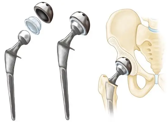 Does hip replacement surgery eliminate all hip pain?