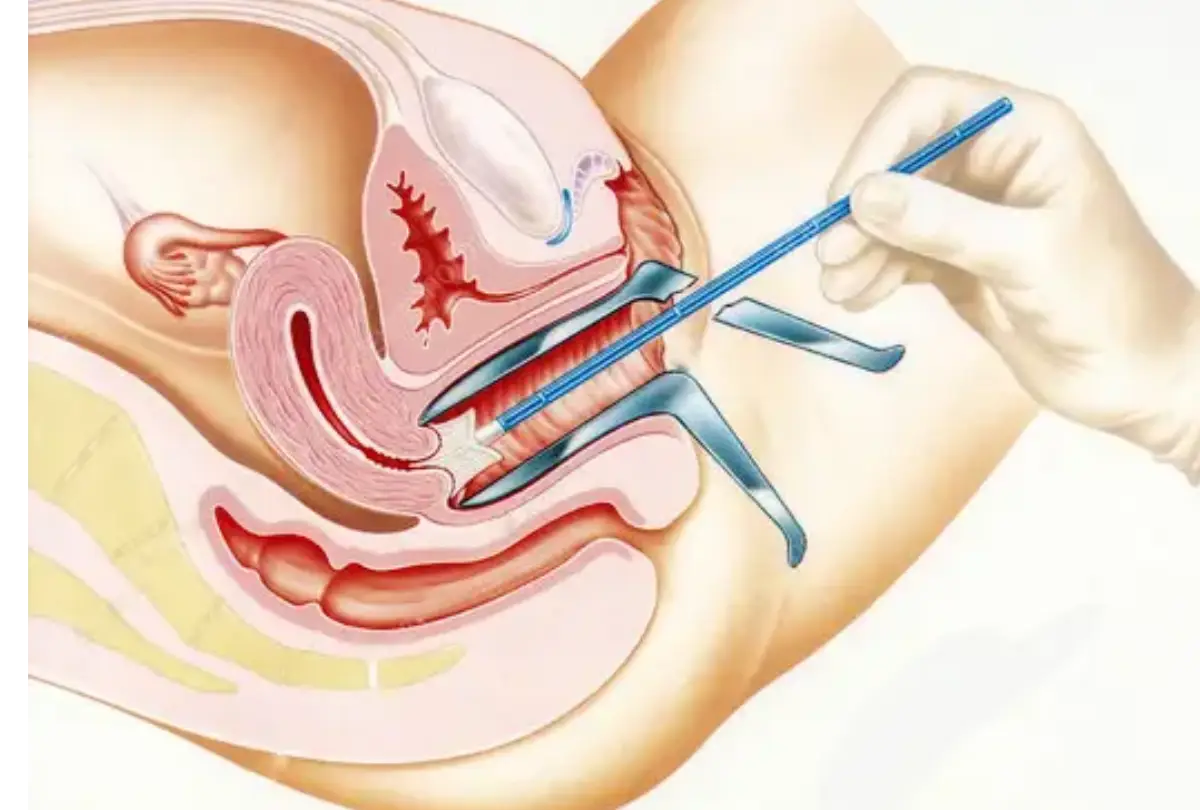 Is it safe to have a Pap smear during pregnancy, and are there any special considerations for pregnant women?